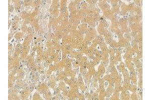 ABIN6257770 and ABIN6275494 at 1/100 staining human hepatocellular carcinoma by IHC-P. (ARHGEF10 Antikörper  (Internal Region))