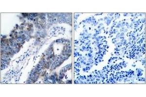 Immunohistochemistry analysis of paraffin-embedded human breast carcinoma tissue, using ASK1 (Ab-83) Antibody. (ASK1 Antikörper  (AA 49-98))