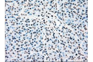 Immunohistochemical staining of paraffin-embedded Carcinoma of kidney tissue using anti-PLK1mouse monoclonal antibody. (PLK1 Antikörper)