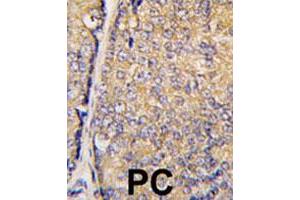 Formalin-fixed and paraffin-embedded human prostate carcinoma tissue reacted with STAP1 polyclonal antibody  , which was peroxidase-conjugated to the secondary antibody, followed by DAB staining. (STAP1 Antikörper  (Phe56))