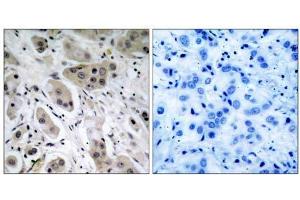 Immunohistochemical analysis of paraffin- embedded human breast carcinoma tissue, using Akt (phospho-Ser473) antibody (E011054). (AKT1 Antikörper  (pSer473))