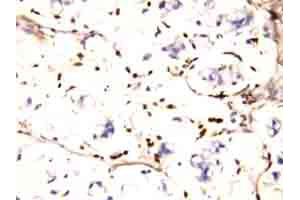 Immunohistochemical staining of IFITM1 on formalin fixed, paraffin embedded human intestines cancer tissue with IFITM1 polyclonal antibody . (IFITM1 Antikörper  (N-Term))