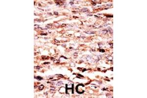 Formalin-fixed and paraffin-embedded human hepatocellular carcinoma tissue reacted with JUN (phospho S63) polyclonal antibody  which was peroxidase-conjugated to the secondary antibody followed by AEC staining. (C-JUN Antikörper  (pSer63))