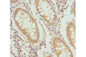 Immunohistochemistry of paraffin-embedded human colon cancer using ABIN7163635 at dilution of 1:100 (PLEKHA1 Antikörper  (AA 285-404))
