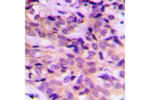 Immunohistochemical analysis of ATG4B staining in human breast cancer formalin fixed paraffin embedded tissue section.