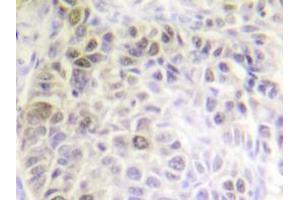Immunohistochemistry analyzes of Ku70 antibody in paraffin-embedded human liver carcinoma tissue. (XRCC6 Antikörper)