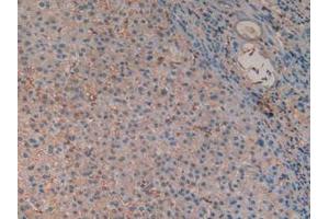 IHC-P analysis of Human Liver Cancer Tissue, with DAB staining. (Hemoglobin Subunit beta Antikörper  (AA 1-147))