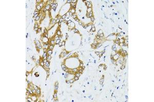Immunohistochemistry of paraffin-embedded human colon carcinoma using SIRT2 antibody. (SIRT2 Antikörper)