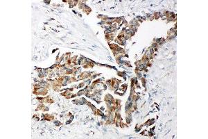 IHC-P: TRAM antibody testing of human lung cancer tissue