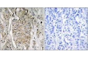 Immunohistochemistry analysis of paraffin-embedded human breast carcinoma tissue, using HER2 Antibody. (ErbB2/Her2 Antikörper  (AA 641-690))