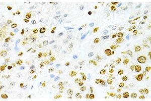 Immunohistochemistry of paraffin-embedded Human liver cancer using DKC1 Polyclonal Antibody at dilution of 1:200 (40x lens). (DKC1 Antikörper)
