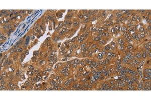 Immunohistochemistry (Paraffin-embedded Sections) (IHC (p)) image for anti-ADAM Metallopeptidase with Thrombospondin Type 1 Motif, 15 (ADAMTS15) antibody (ABIN7234814)