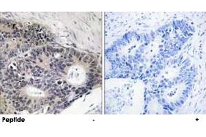 Immunohistochemistry analysis of paraffin-embedded human colon carcinoma tissue using ABHD12B polyclonal antibody . (ABHD12B Antikörper)
