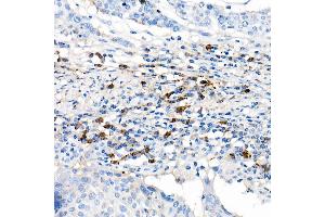 Immunohistochemistry of paraffin-embedded human cervix cancer using Lambda Light chain Rabbit mAb (ABIN7267847) at dilution of 1:100 (40x lens). (IGLV1-51 Antikörper)