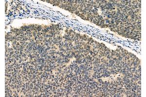 ABIN6262864 and ABIN6277023 at 1/100 staining Human esophageal cancer by IHC-P.