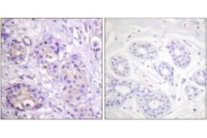 Immunohistochemistry analysis of paraffin-embedded human breast carcinoma, using IKK-beta (Phospho-Tyr199) Antibody. (IKBKB Antikörper  (pTyr199))