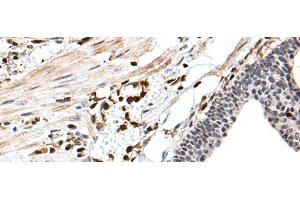 Immunohistochemistry of paraffin-embedded Human gastric cancer tissue using ARHGDIB Polyclonal Antibody at dilution of 1:35(x200) (ARHGDIB Antikörper)