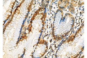 ABIN6262636 and ABIN6276998 at 1/100 staining Human gastric cancer and adjacent normal tissues by IHC-P. (Importin 5 Antikörper  (Internal Region))
