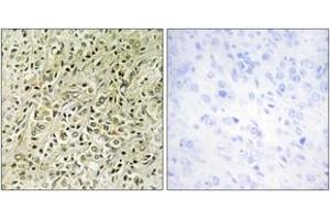 Immunohistochemistry analysis of paraffin-embedded human prostate carcinoma tissue, using RHG07 Antibody. (DLC1 Antikörper  (AA 61-110))
