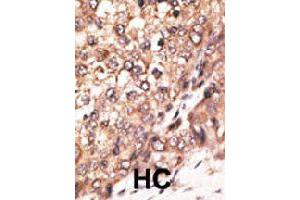 Formalin-fixed and paraffin-embedded human hepatocellular carcinoma tissue reacted with BMP7 polyclonal antibody  , which was peroxidase-conjugated to the secondary antibody, followed by DAB staining. (BMP7 Antikörper  (N-Term))