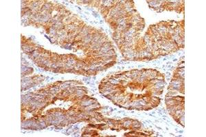 IHC testing of FFPE human colon carcinoma with TL1A antibody (clone TLRM1-1). (TNFSF15 Antikörper)