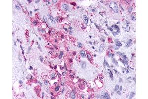 Anti-KISS1R / GPR54 antibody IHC of human Pancreas, Carcinoma. (KISS1R Antikörper  (Cytoplasmic Domain))
