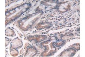 IHC-P analysis of Human Stomach Cancer Tissue, with DAB staining. (IL-10 Antikörper  (AA 19-178))