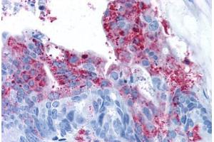 Human Colon Carcinoma (formalin-fixed, paraffin-embedded) stained with GPR124 antibody ABIN213374 at 11 ug/ml followed by biotinylated goat anti-rabbit IgG secondary antibody ABIN481713, alkaline phosphatase-streptavidin and chromogen. (GPR124 Antikörper  (N-Term))
