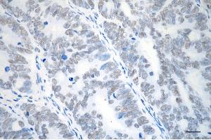 Immunohistochemistry was performed on paraffin-embedded human sigmoid colon carcinoma using SMC3 antibody (ABIN7800448), 1:200). (Rekombinanter SMC3 Antikörper)