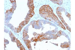 Formalin-fixed, paraffin-embedded human Prostate Carcinoma stained with HLA-DR Mouse Monoclonal Antibody (TAL 1B5). (HLA-DR Antikörper)