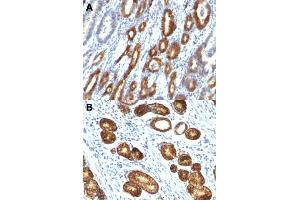 Immunohistochemical staining (Formalin-fixed paraffin-embedded sections) of human gastric carcinoma (A, B) with MUC6 monoclonal antibody, clone MUC6/916 . (MUC6 Antikörper)