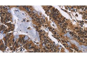 Immunohistochemistry of paraffin-embedded Human colon cancer tissue using EPHB6 Polyclonal Antibody at dilution 1:50 (EPH Receptor B6 Antikörper)