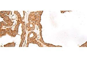 Immunohistochemistry of paraffin-embedded Human thyroid cancer tissue using GBGT1 Polyclonal Antibody at dilution of 1:40(x200) (GBGT1 Antikörper)
