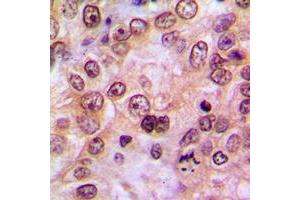 Immunohistochemical analysis of LIMK1/2 (pT508/505) staining in human breast cancer formalin fixed paraffin embedded tissue section. (LIMK-1/2 (C-Term), (pSer505), (pSer508) Antikörper)