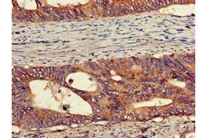 Immunohistochemistry of paraffin-embedded human colon cancer using ABIN7175913 at dilution of 1:100 (PEPD Antikörper  (AA 258-395))