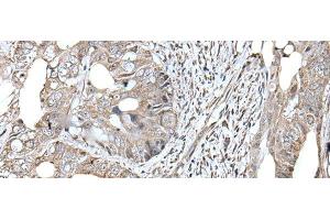 Immunohistochemistry of paraffin-embedded Human colorectal cancer tissue using RAD54B Polyclonal Antibody at dilution of 1:45(x200) (RAD54B Antikörper)
