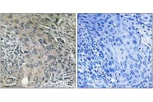 Immunohistochemistry analysis of paraffin-embedded human cervix carcinoma tissue, using COPZ1 Antibody. (COPZ1 Antikörper  (AA 11-60))