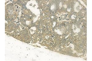ABIN6255345 and ABIN6267144 at 1/100 staining human ovarian carcinoma by IHC-P.