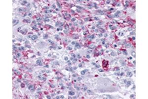 Anti-OPRM1 / Mu Opioid Receptor antibody IHC of human Brain, Glioblastoma. (Mu Opioid Receptor 1 Antikörper  (C-Term))