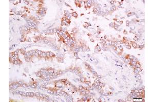 Paraformaldehyde-fixed, paraffin embedded human lung carcinoma tissue, Antigen retrieval by boiling in sodium citrate buffer(pH6) for 15min, Block endogenous peroxidase by 3% hydrogen peroxide for 30 minutes, Blocking buffer (normal goat serum) at 37°C for 20min, Antibody incubation with Rabbit Anti-CD300A/C Polyclonal Antibody, Unconjugated  at 1:200 overnight at 4°C, followed by a conjugated secondary and DAB staining (CD300A/ C (AA 20-70) Antikörper)
