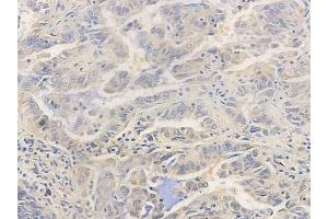 ABIN6255718 and ABIN6267407 at 1/100 staining human lung adenocarcinoma by IHC-P.