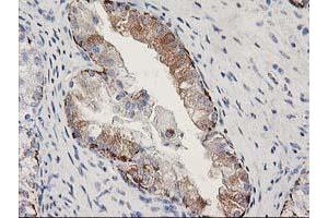 Immunohistochemical staining of paraffin-embedded Adenocarcinoma of Human ovary tissue using anti-MGLL mouse monoclonal antibody. (MGLL Antikörper)