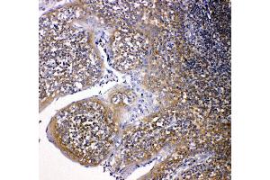 Anti-NOX2/gp91phox antibody, IHC(P) IHC(P): Human Intestinal Cancer Tissue