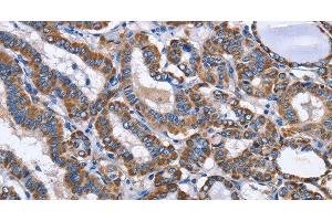 Immunohistochemistry of paraffin-embedded Human thyroid cancer using INTS10 Polyclonal Antibody at dilution of 1:50 (INTS10 Antikörper)