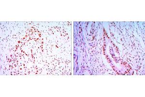 Immunohistochemical analysis of paraffin-embedded lung cancer tissues (left) and colon cancer tissues (right) using CDC27 mouse mAb with DAB staining. (CDC27 Antikörper)
