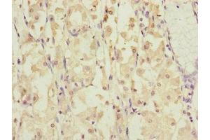 Immunohistochemistry of paraffin-embedded human gastric cancer using ABIN7149316 at dilution of 1:100 (DYNC1I1 Antikörper  (AA 1-220))