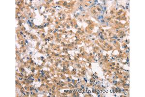 Immunohistochemistry of Human liver cancer using LATS2 Polyclonal Antibody at dilution of 1:30 (LATS2 Antikörper)
