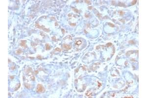 Formalin-fixed, paraffin-embedded human Stomach Carcinoma stained with pS2 Rabbit Recombinant Monoclonal Antibody (TFF1/2969R). (Rekombinanter TFF1 Antikörper  (AA 57-84))