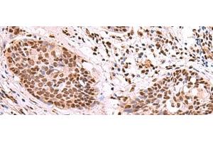 Immunohistochemistry of paraffin-embedded Human esophagus cancer tissue using SF3B3 Polyclonal Antibody at dilution of 1:70(x200) (SF3B3 Antikörper)