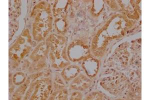 Immunohistochemistry of paraffin-embedded human colon cancer using ABIN7174308 at dilution of 1:100 (USP3 Antikörper  (C-Term))